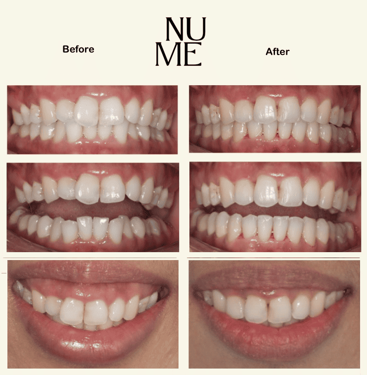 Invisalign - Before and After Treatment 1