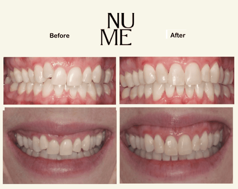 Invisalign - Before and After Treatment