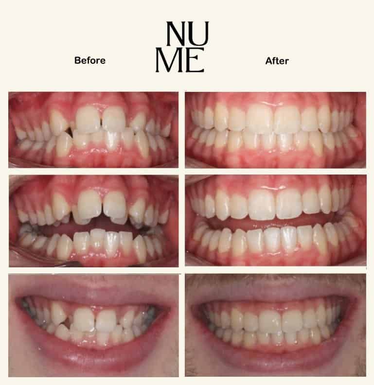 Invisalign Treatment - Before and After