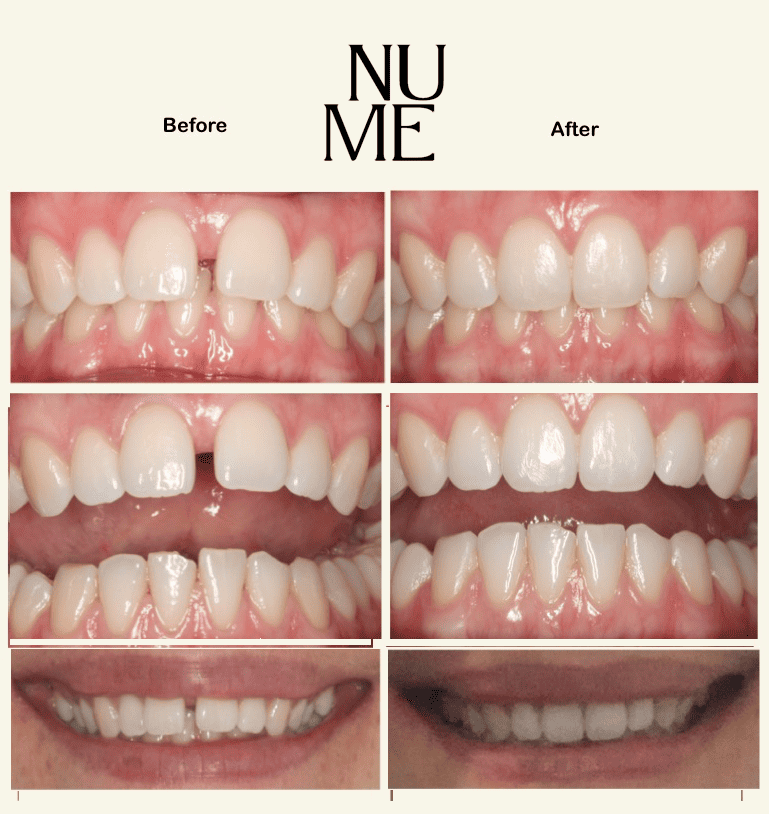 Invisalign Treatment - Before&After