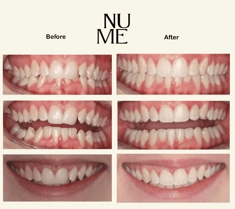 Web Invisalign-BeforeandAfter